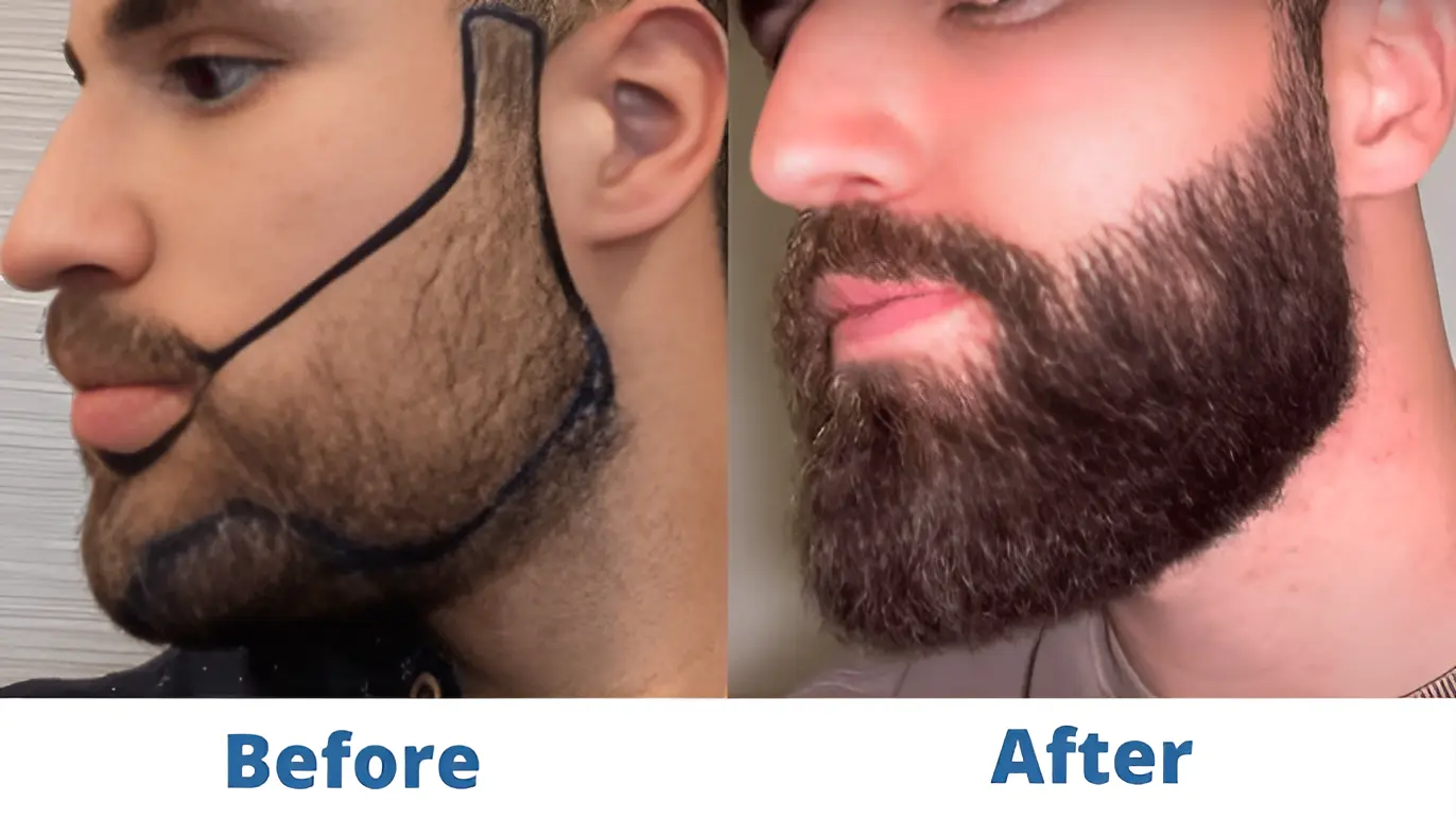 Before and After Hair Transplant