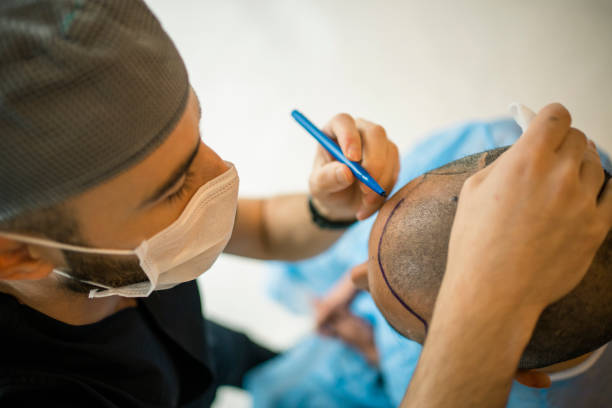 Hair Transplant Procedure